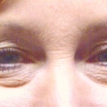 Before upper & lower blepharoplasty