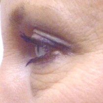 Before upper & lower blepharoplasty